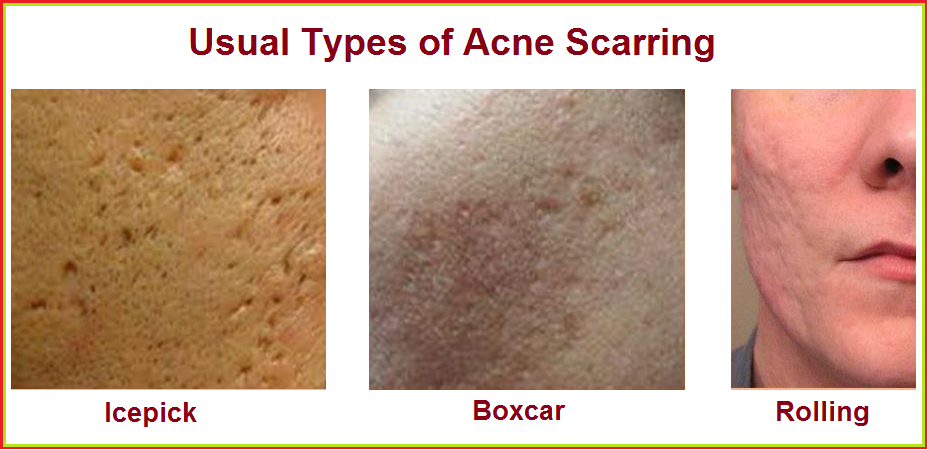 types-of-acne-scars-skinhampshire-wrinkle-reduction-treatment-in