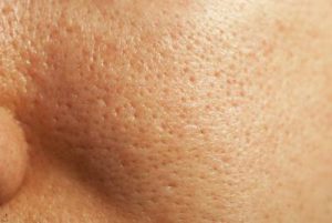 large open pores