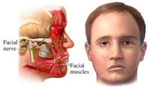 hemifacial spasm